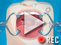 Operate now: Tonsil surgery Walktrough
